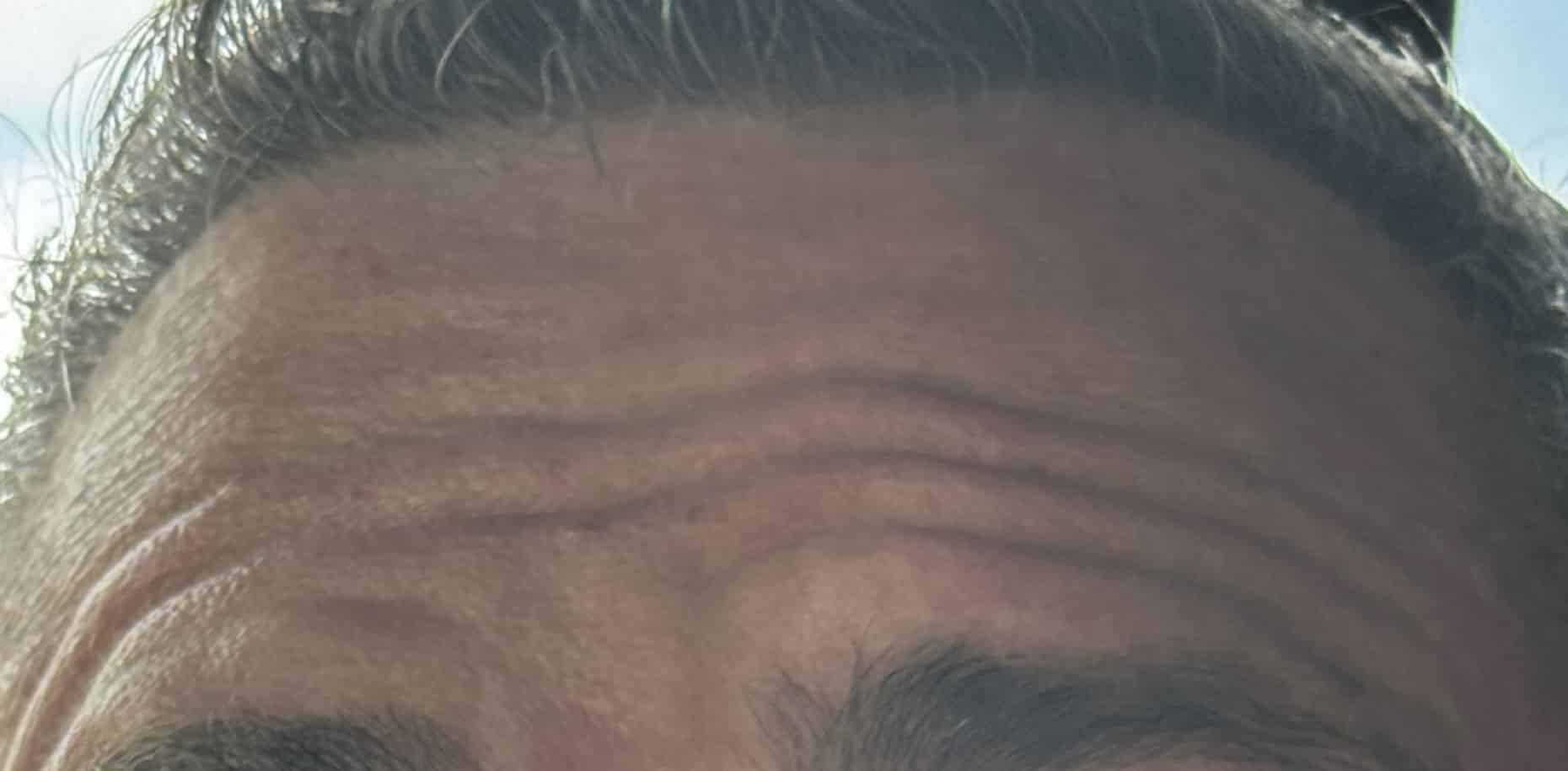 After Image: Botox - front