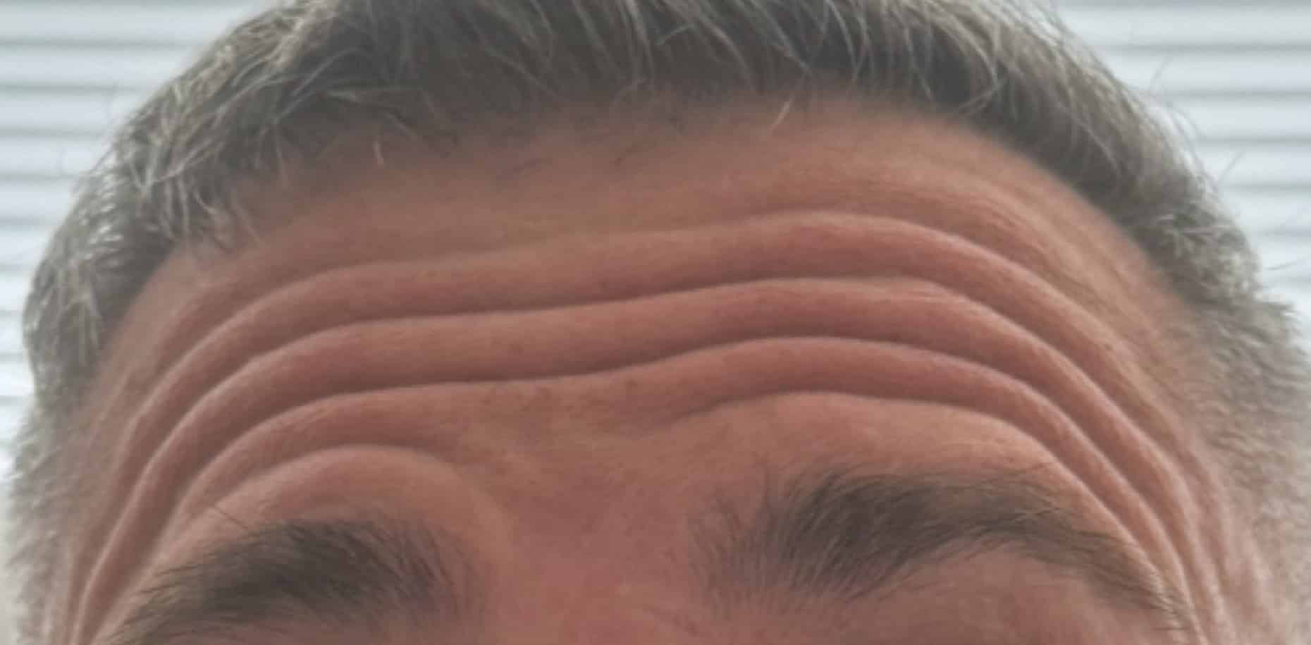 Before Image: Botox - front