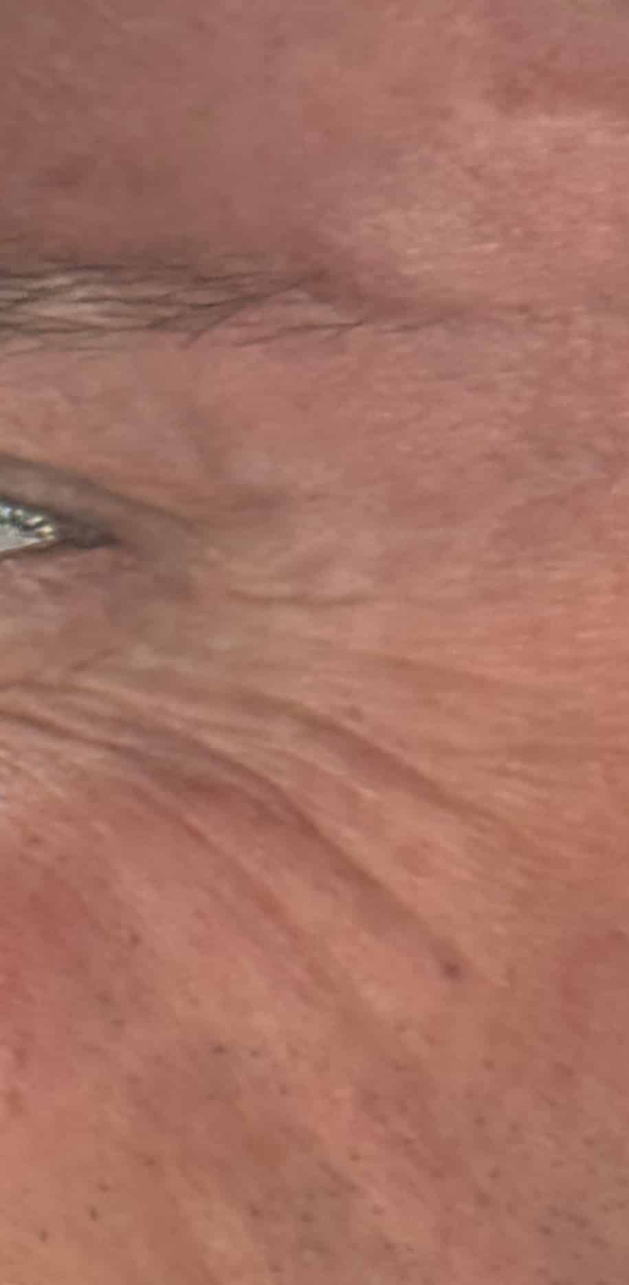 After Image: Botox - left-side