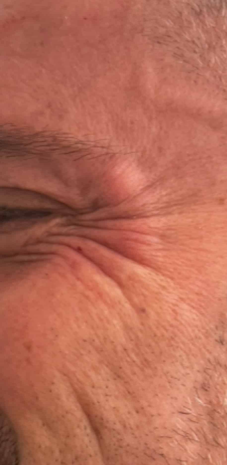 Before Image: Botox - left-side