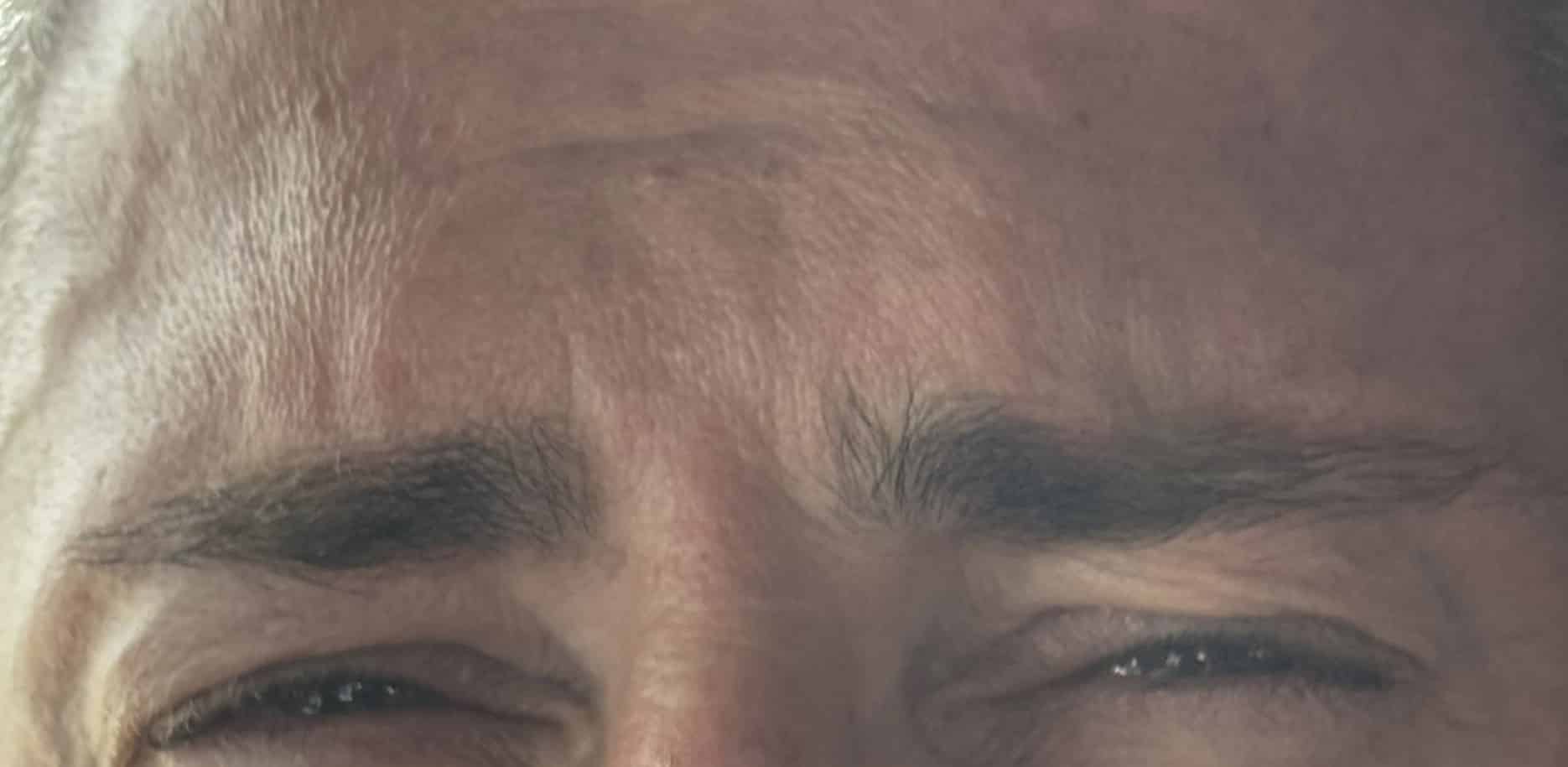 After Image: Botox - front