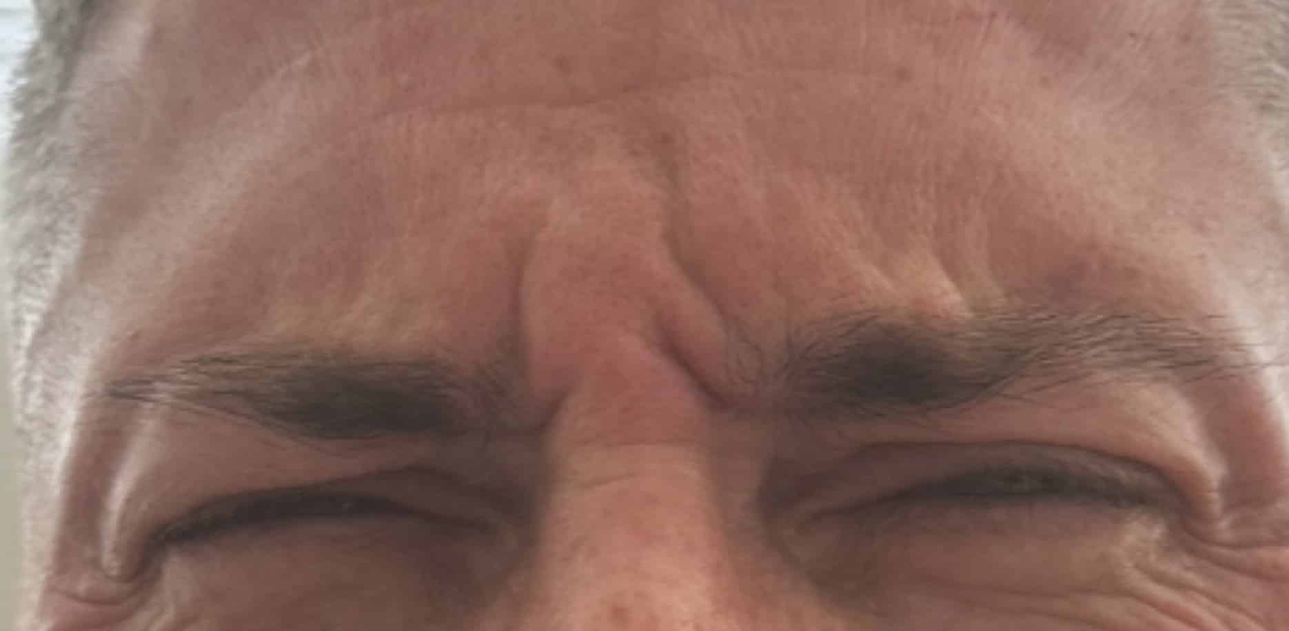 Before Image: Botox - front