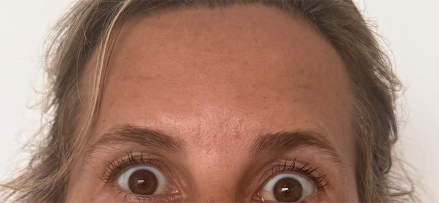 After Image: Botox - front