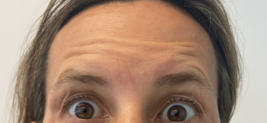 Before Image: Botox - front