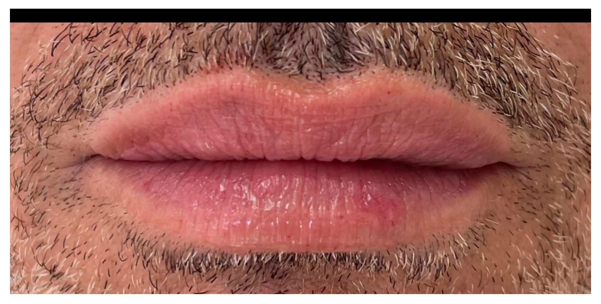 After Image: Lip Filler - front