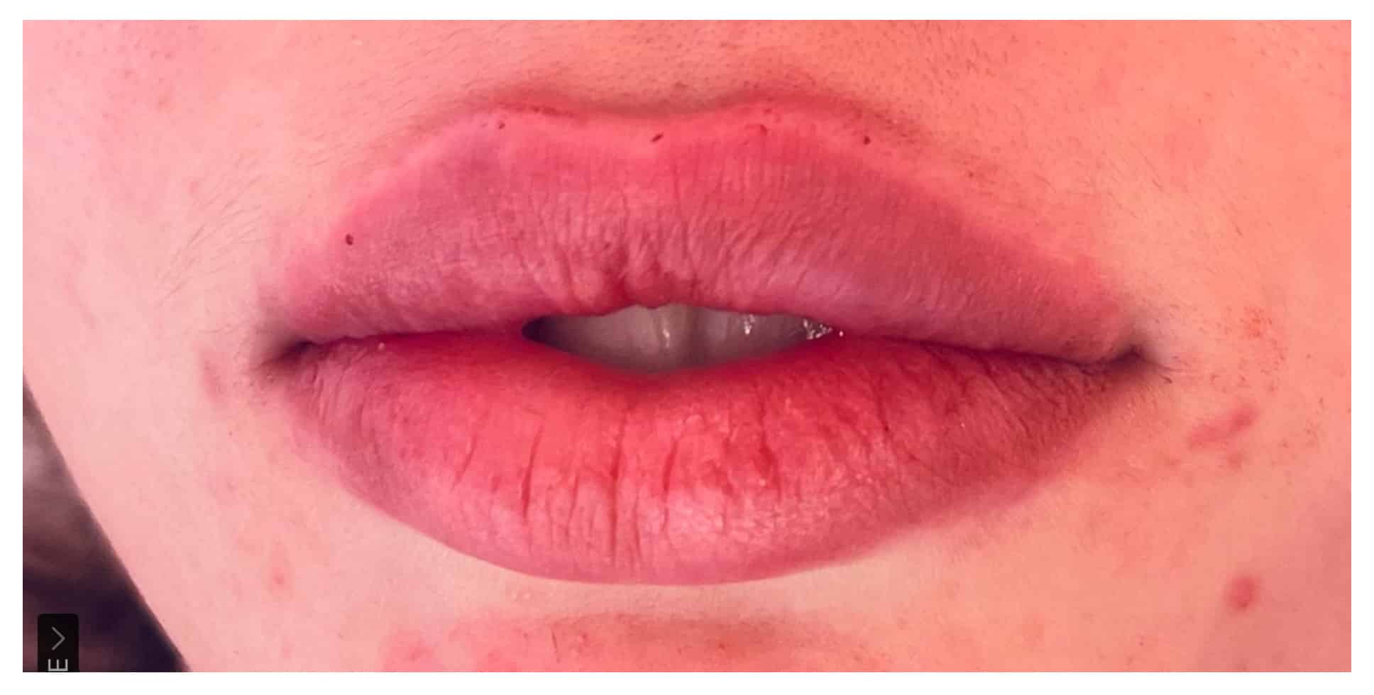 After Image: Lip Filler - front