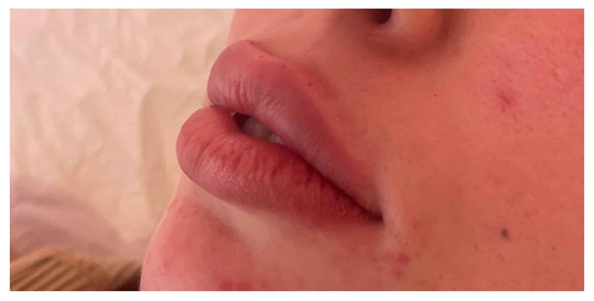After Image: Lip Filler - left-front-oblique
