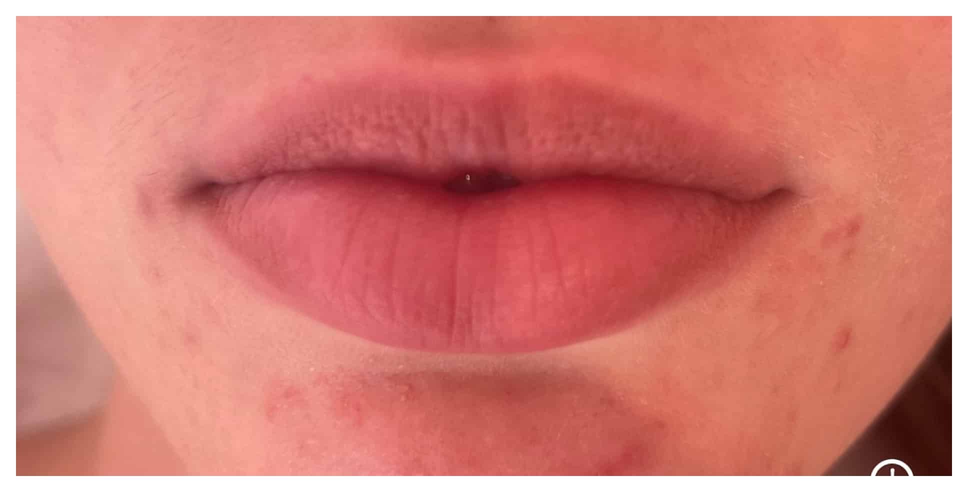 Before Image: Lip Filler - front