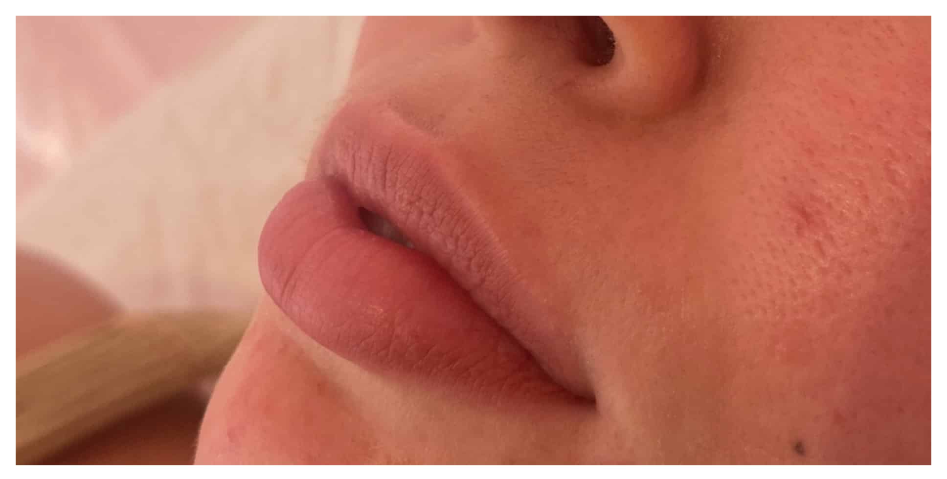 Before Image: Lip Filler - left-front-oblique