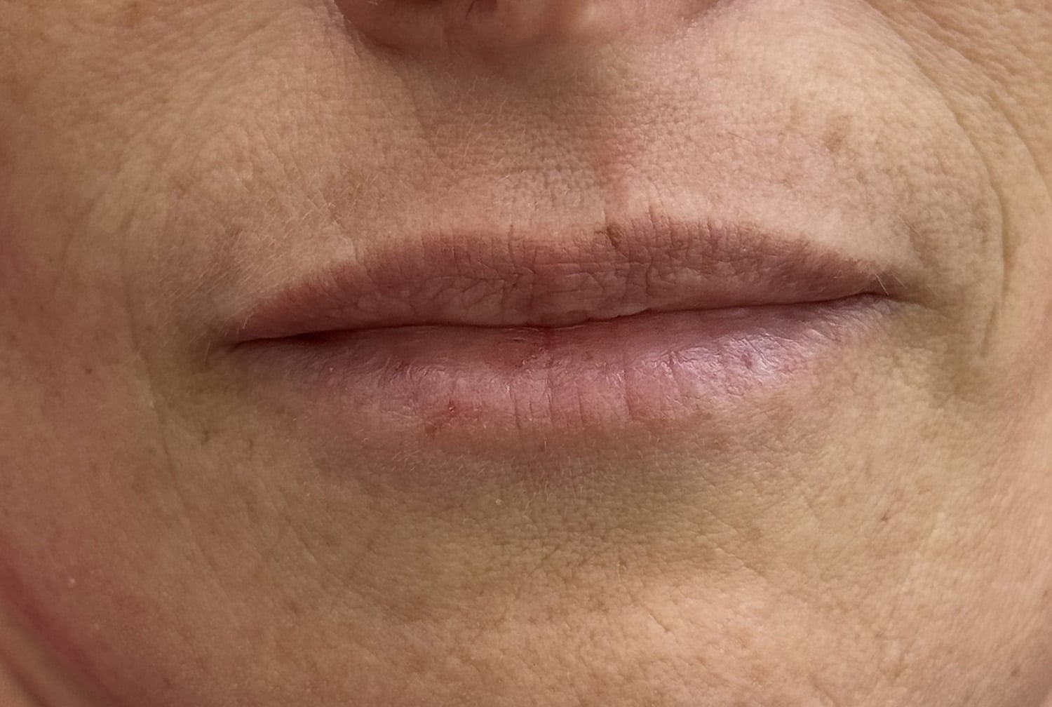 Before Image: Lip Filler - front
