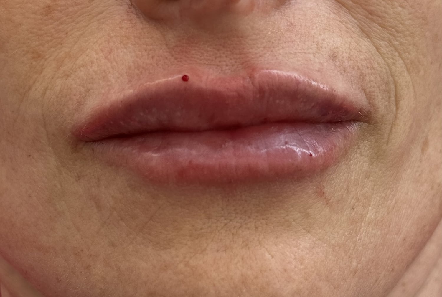 After Image: Lip Filler - front