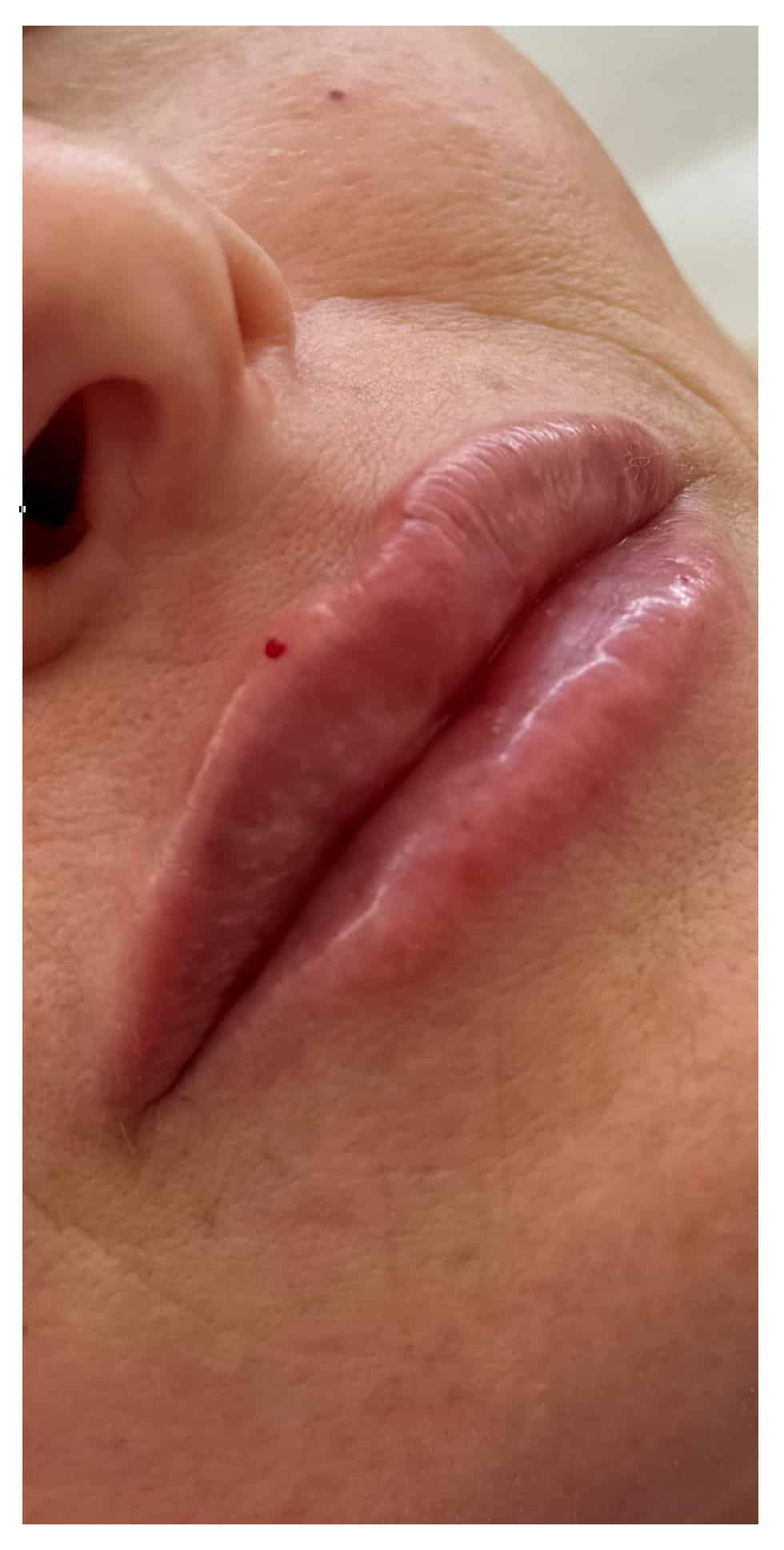 After Image: Lip Filler - right-front-oblique