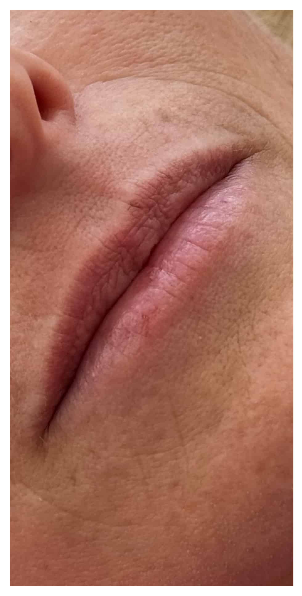 Before Image: Lip Filler - right-front-oblique