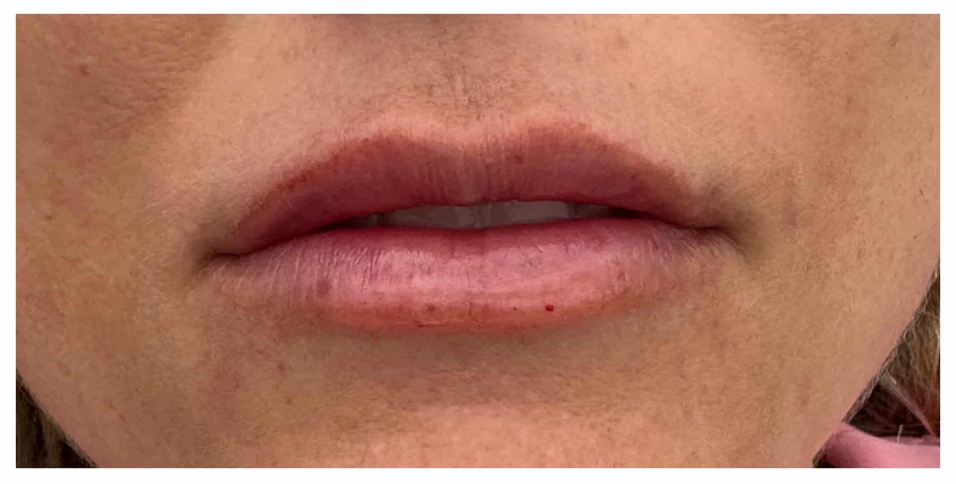 After Image: Lip Filler - front
