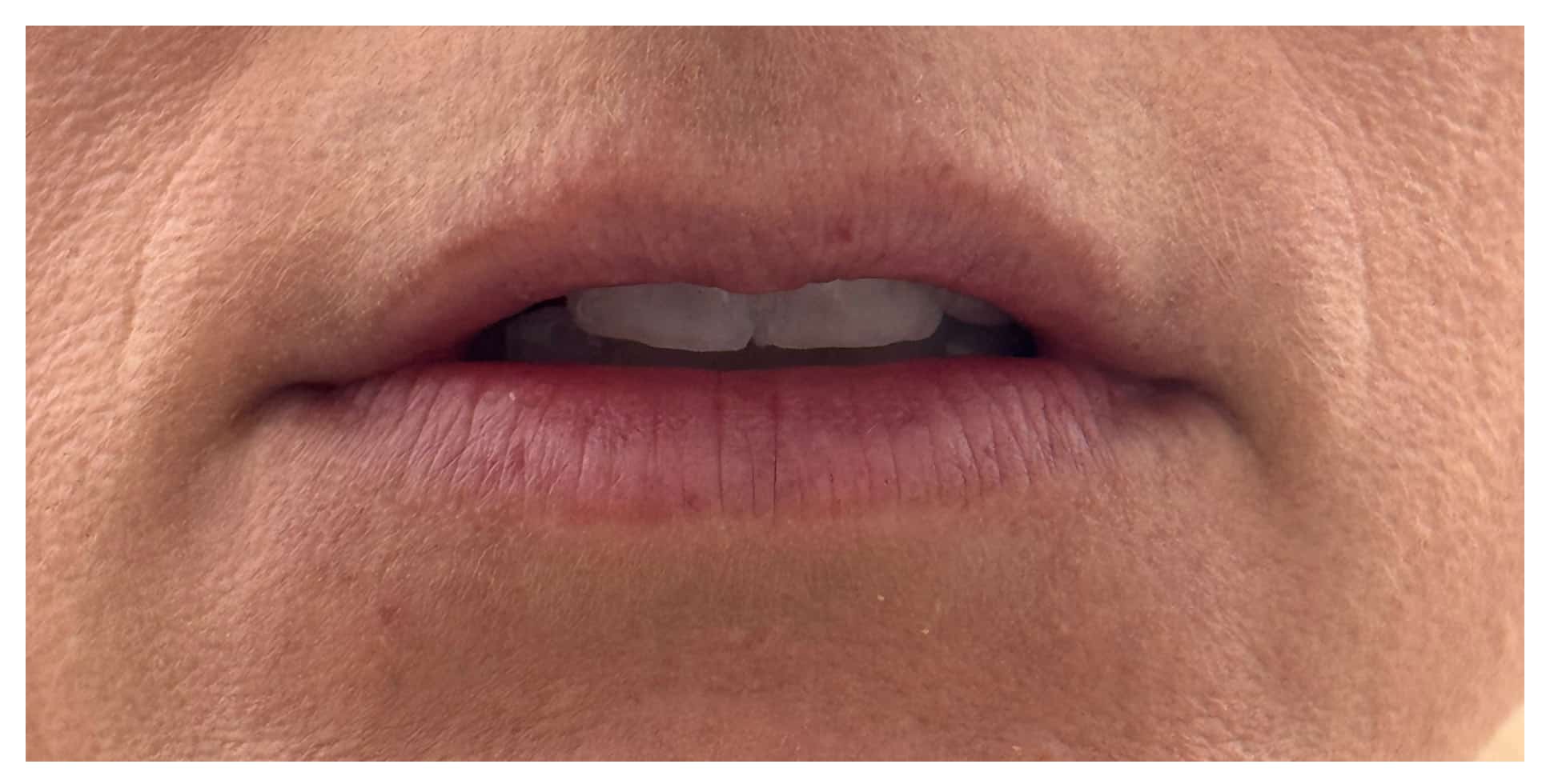 Before Image: Lip Filler - front