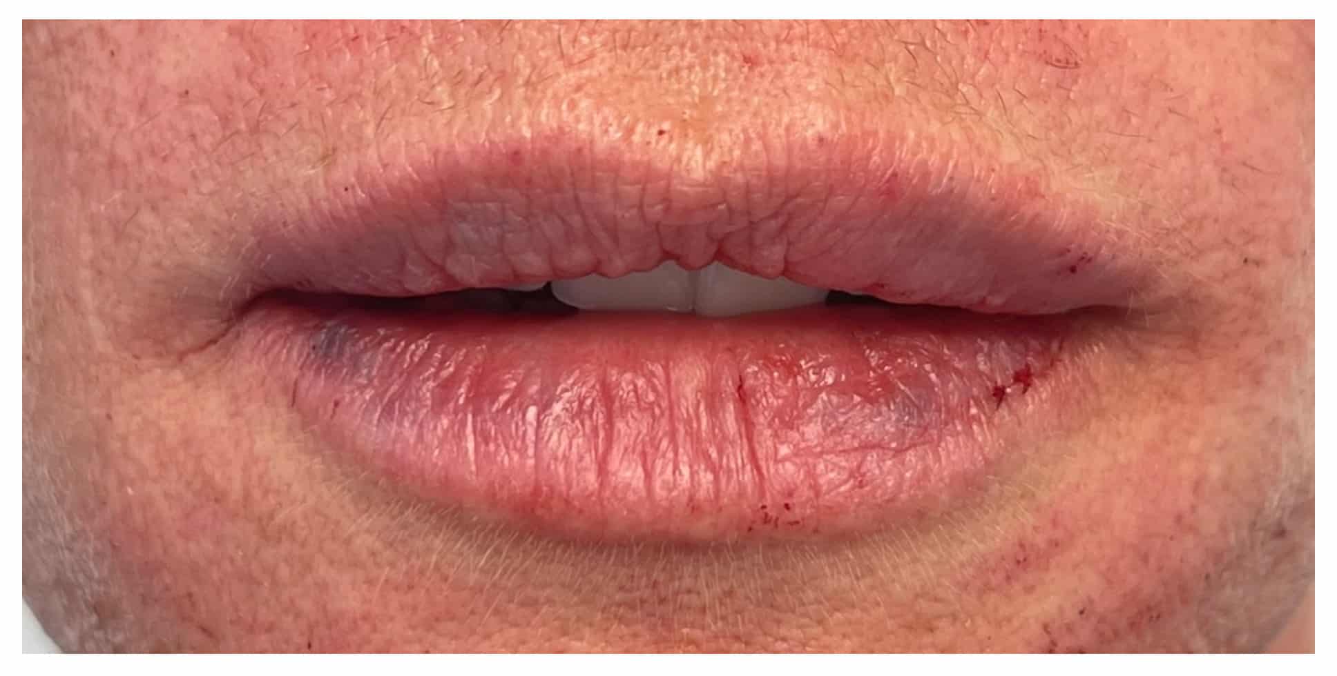 After Image: Lip Filler - front