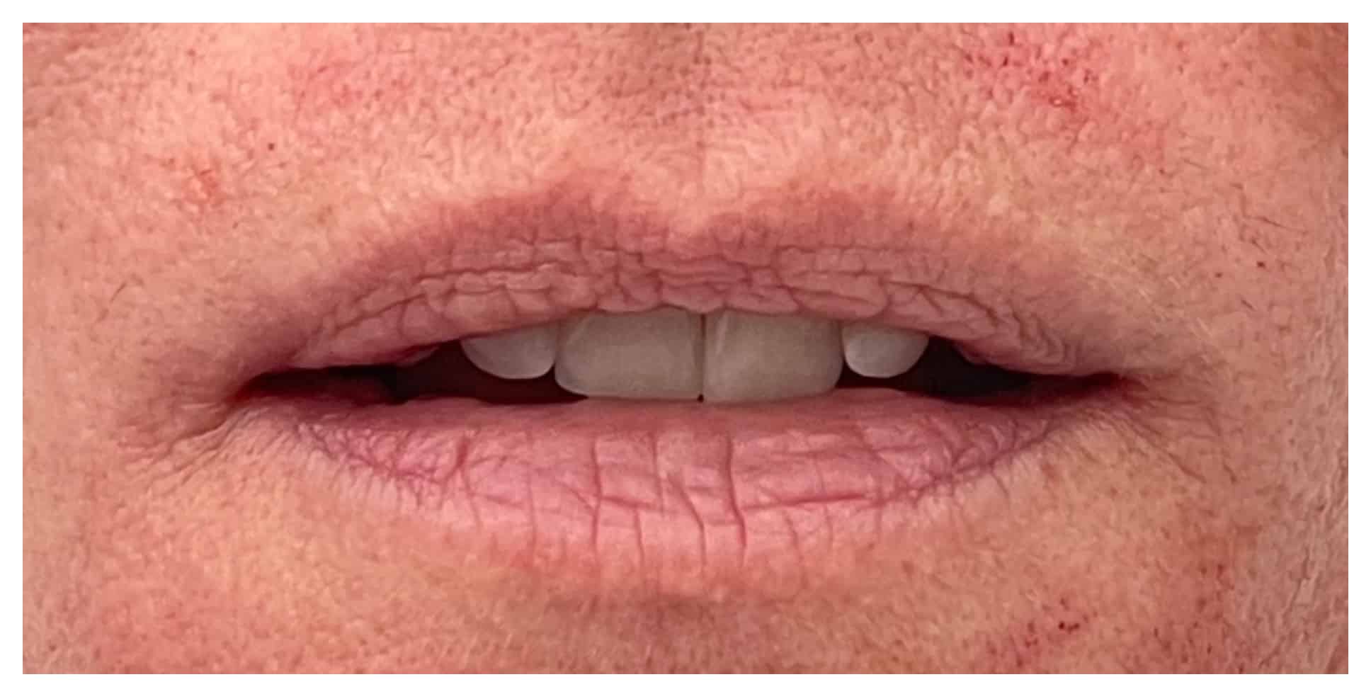 Before Image: Lip Filler - front