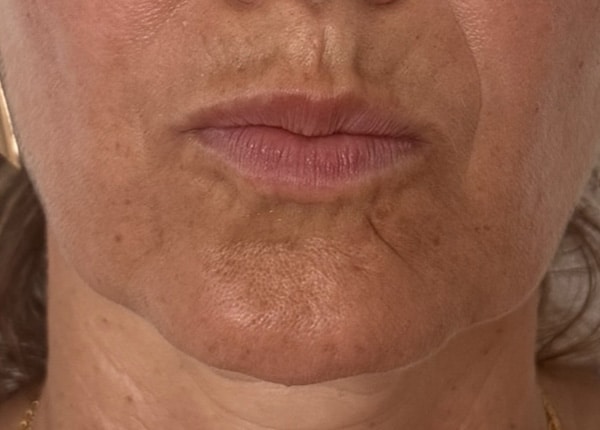 After Image: Lip Filler - front