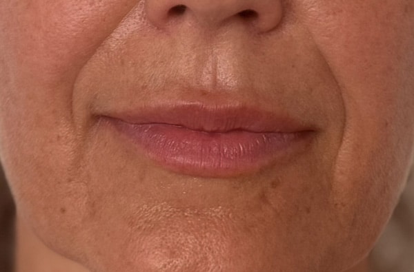 After Image: Lip Filler - front