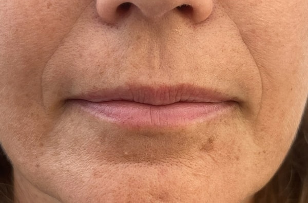 Before Image: Lip Filler - front