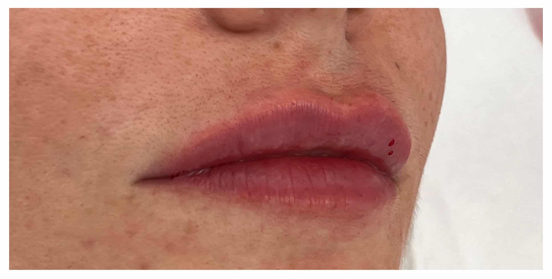 After Image: Lip Filler - right-front-oblique