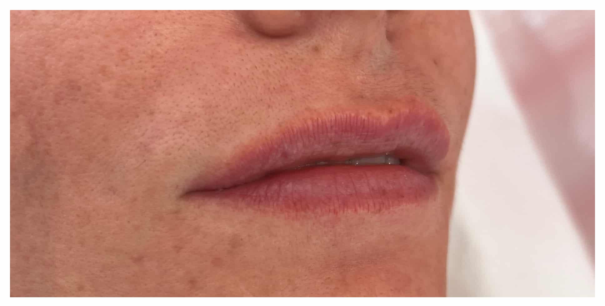 Before Image: Lip Filler - right-front-oblique