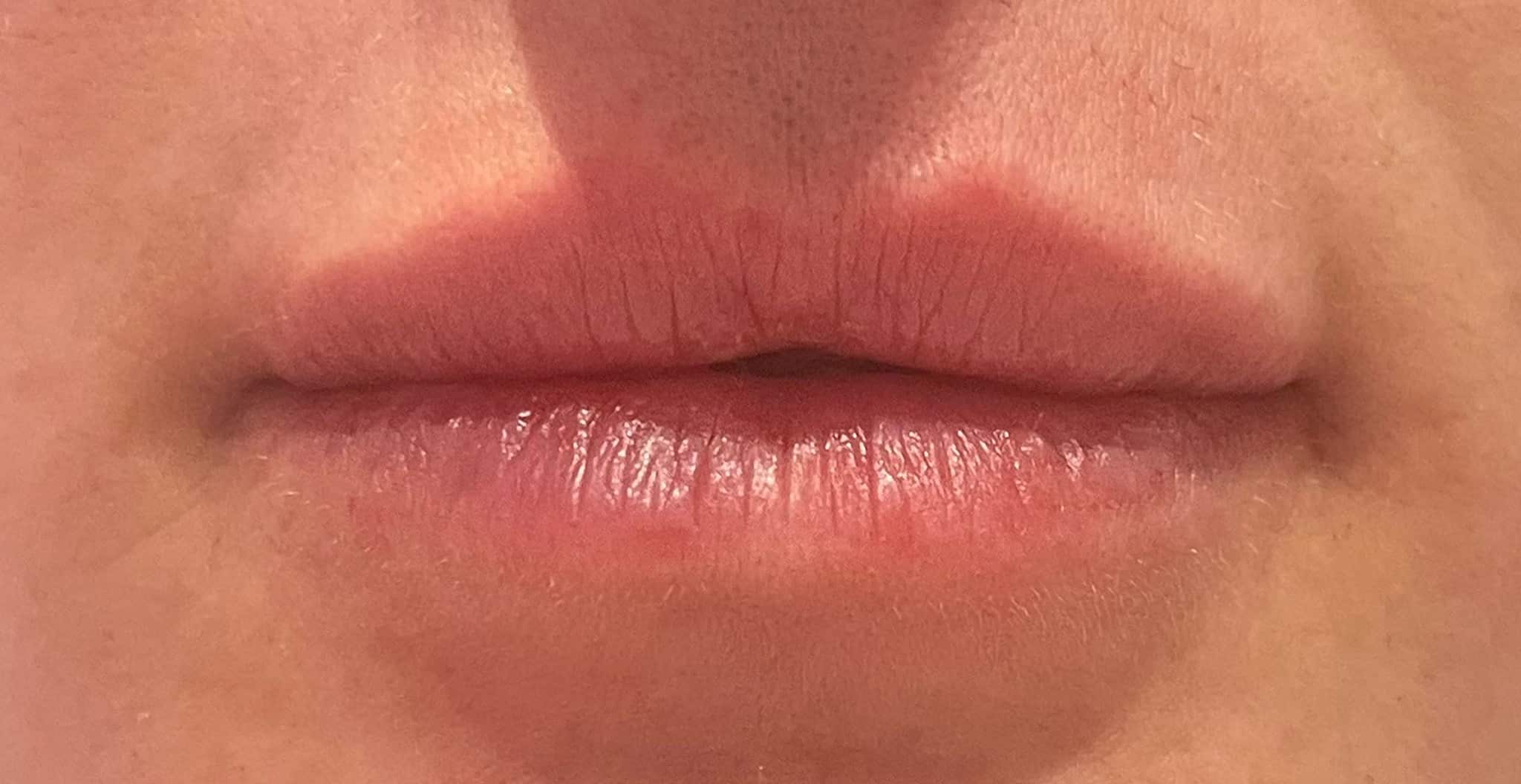 After Image: Lip Filler - front