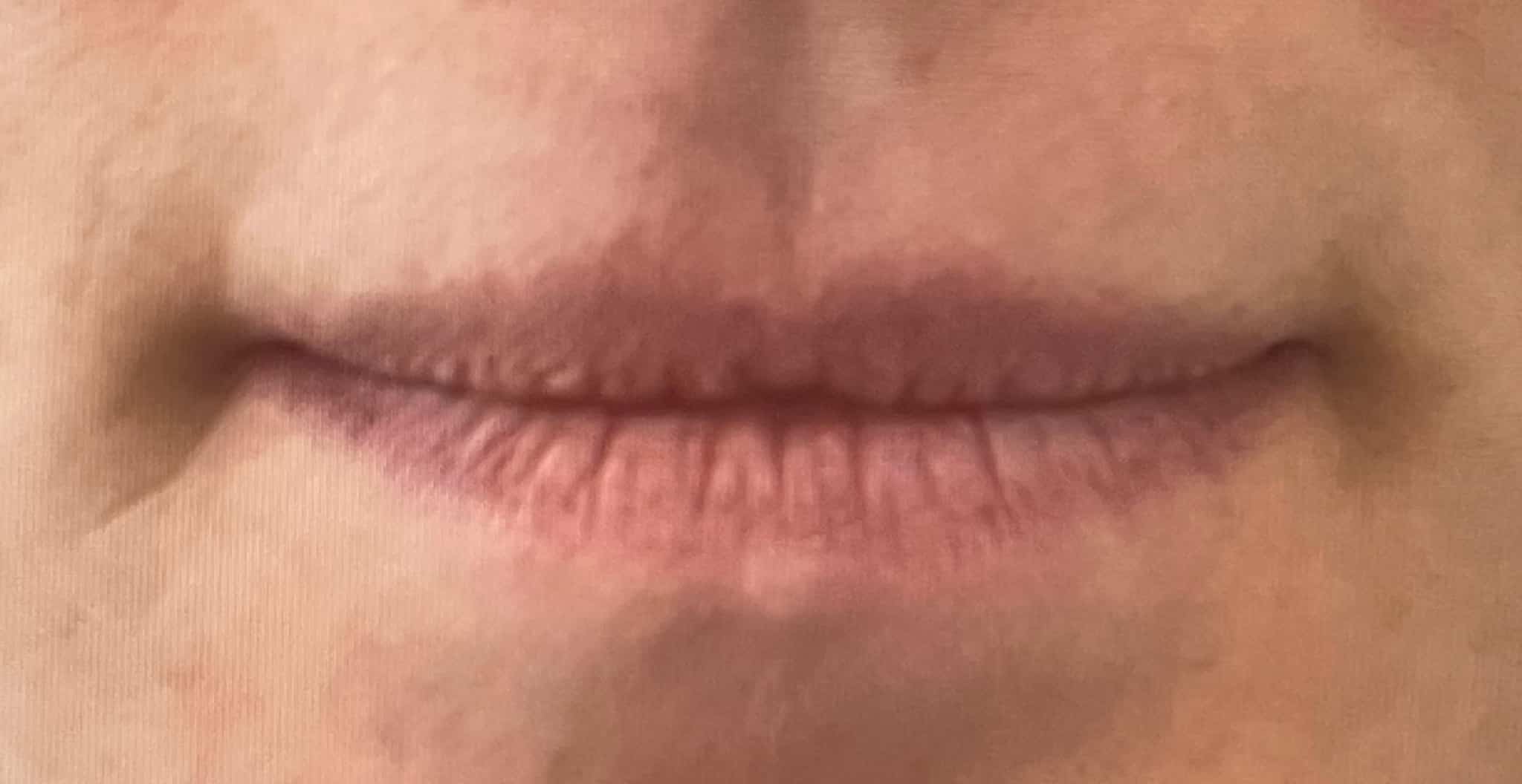 Before Image: Lip Filler - front