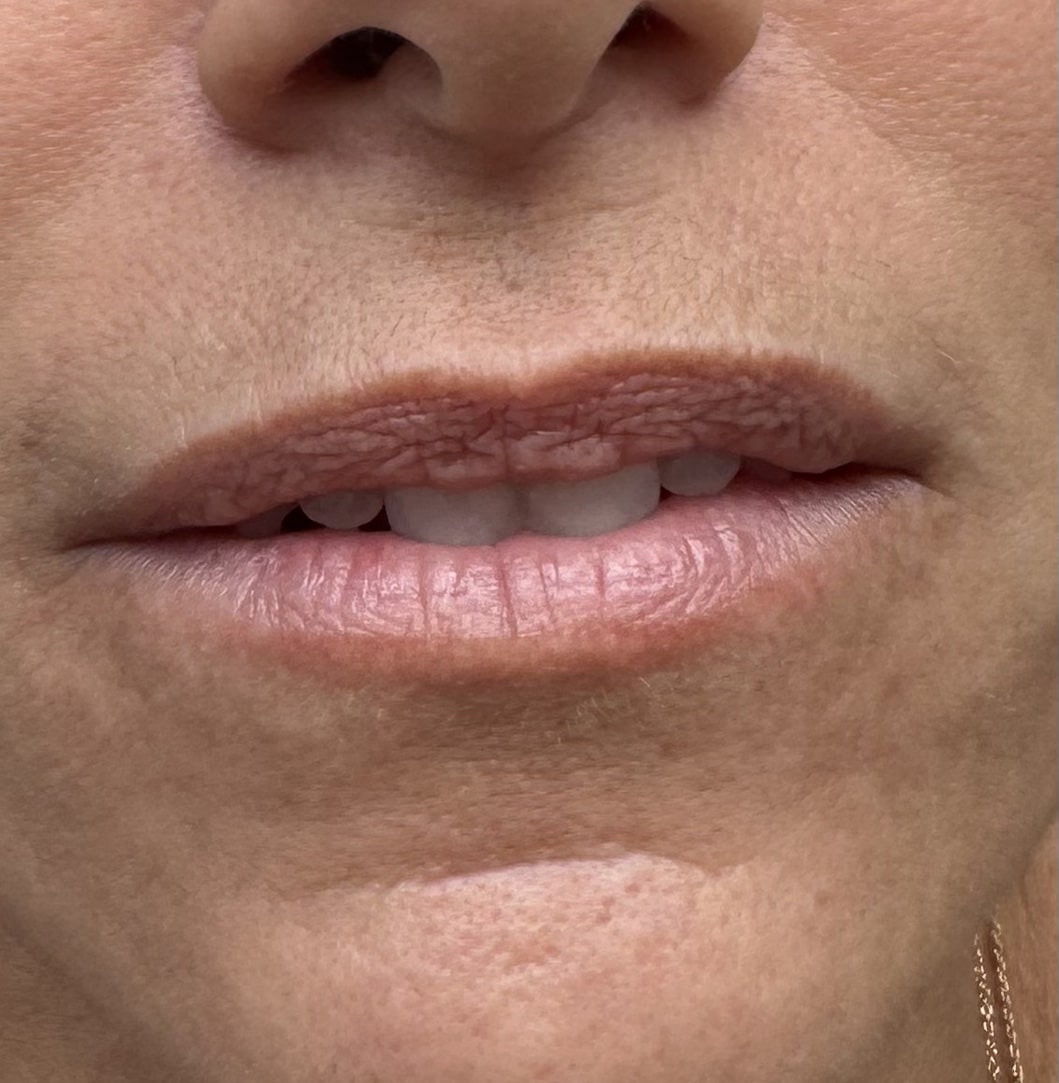 Before Image: Lip Filler - front