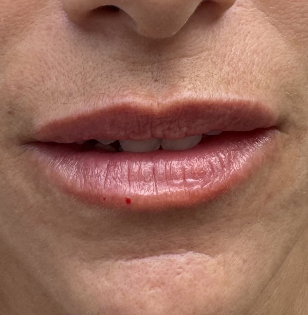 After Image: Lip Filler - front