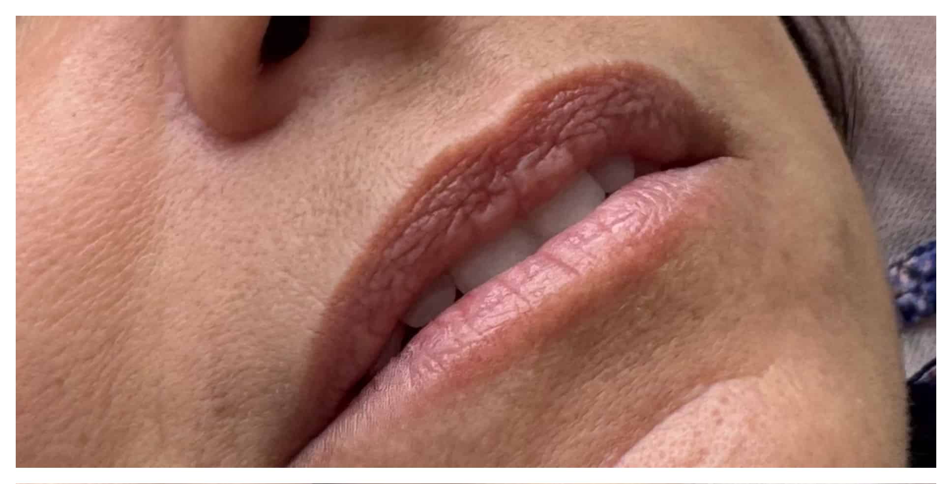 Before Image: Lip Filler - right-front-oblique