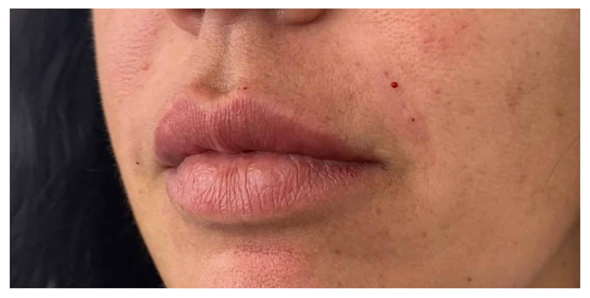 After Image: Lip Filler - left-front-oblique