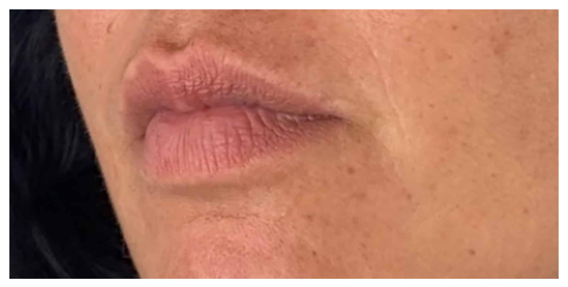 Before Image: Lip Filler - left-front-oblique
