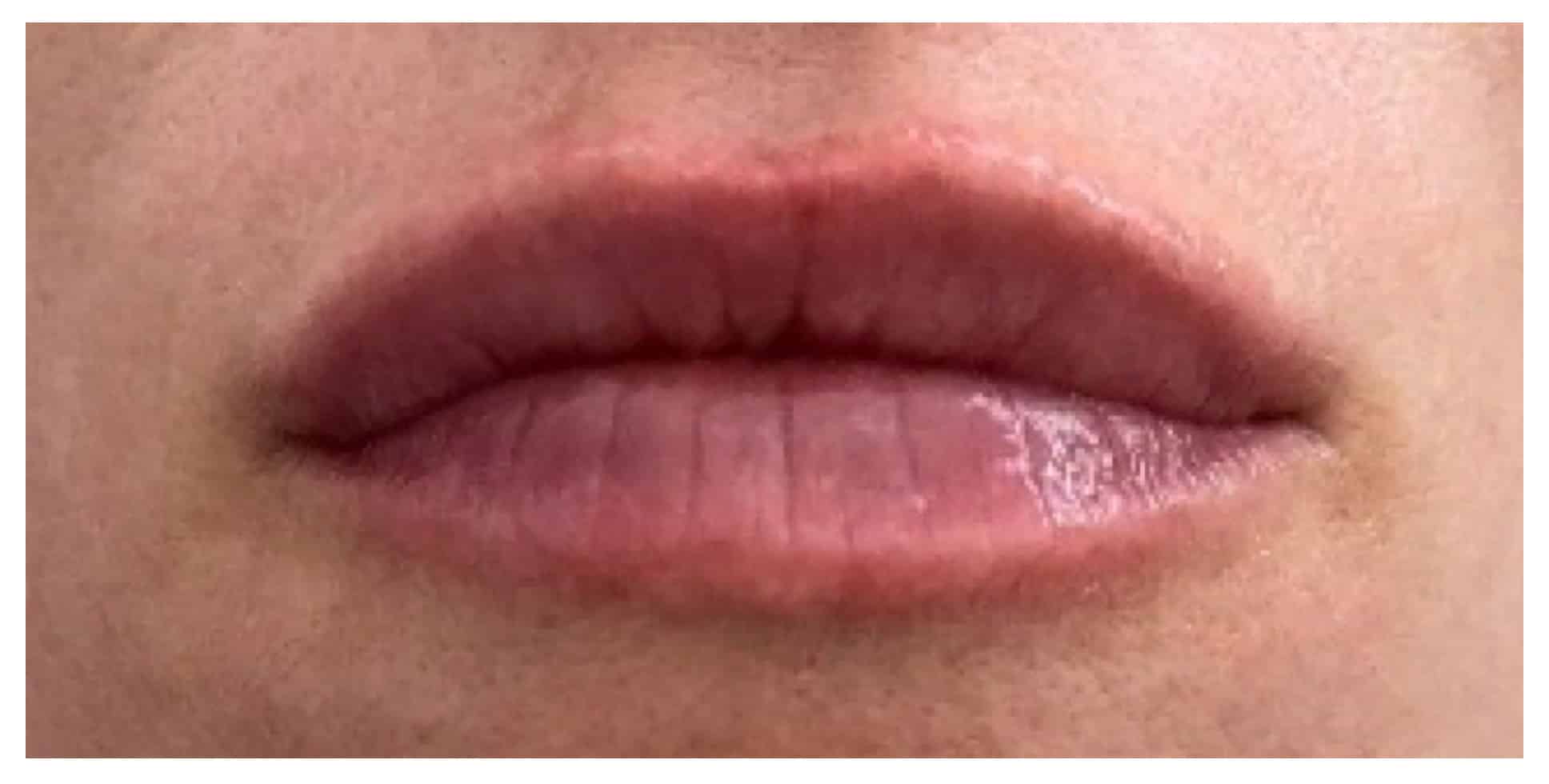 After Image: Lip Filler - front