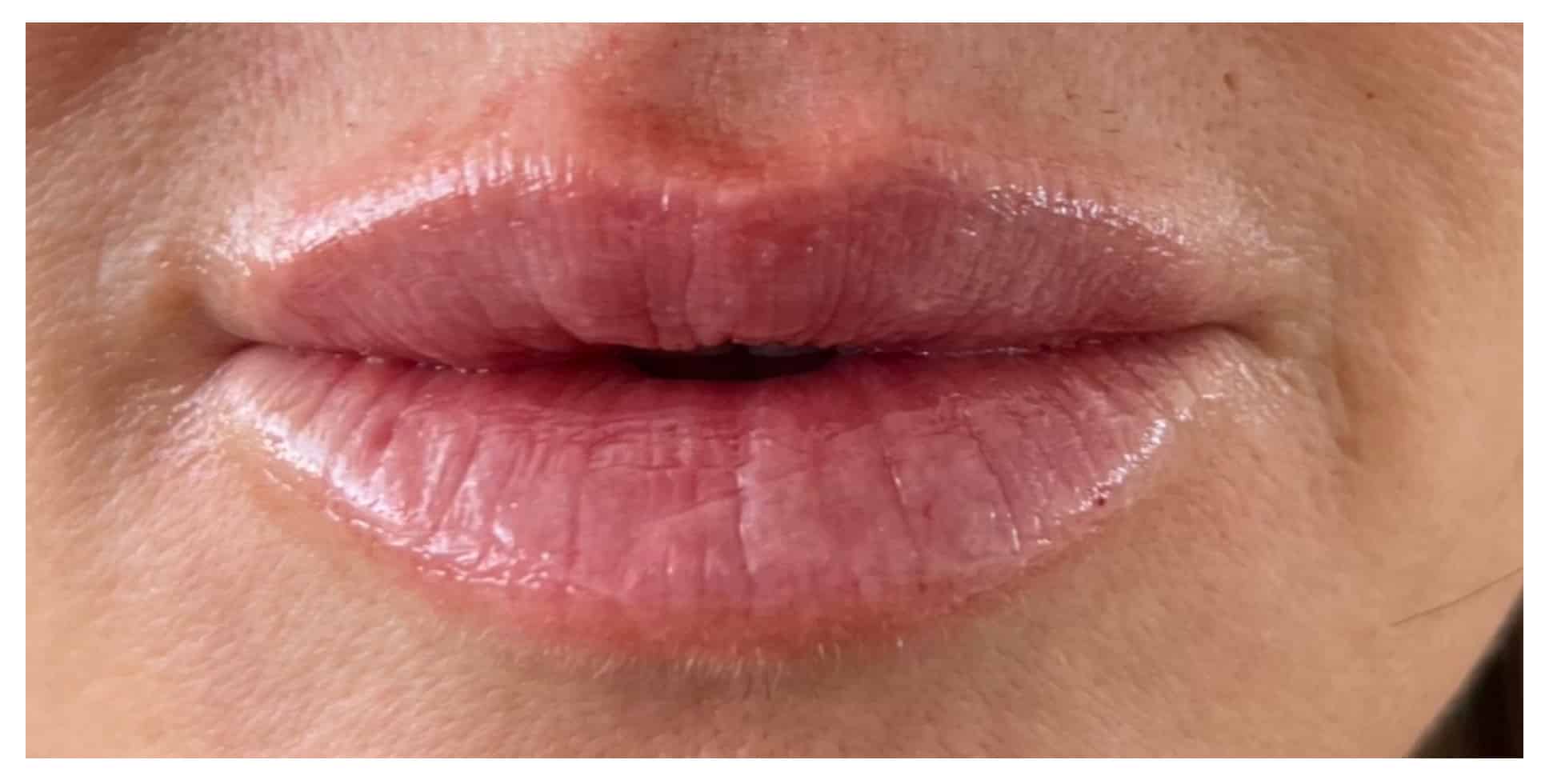 After Image: Lip Filler - front