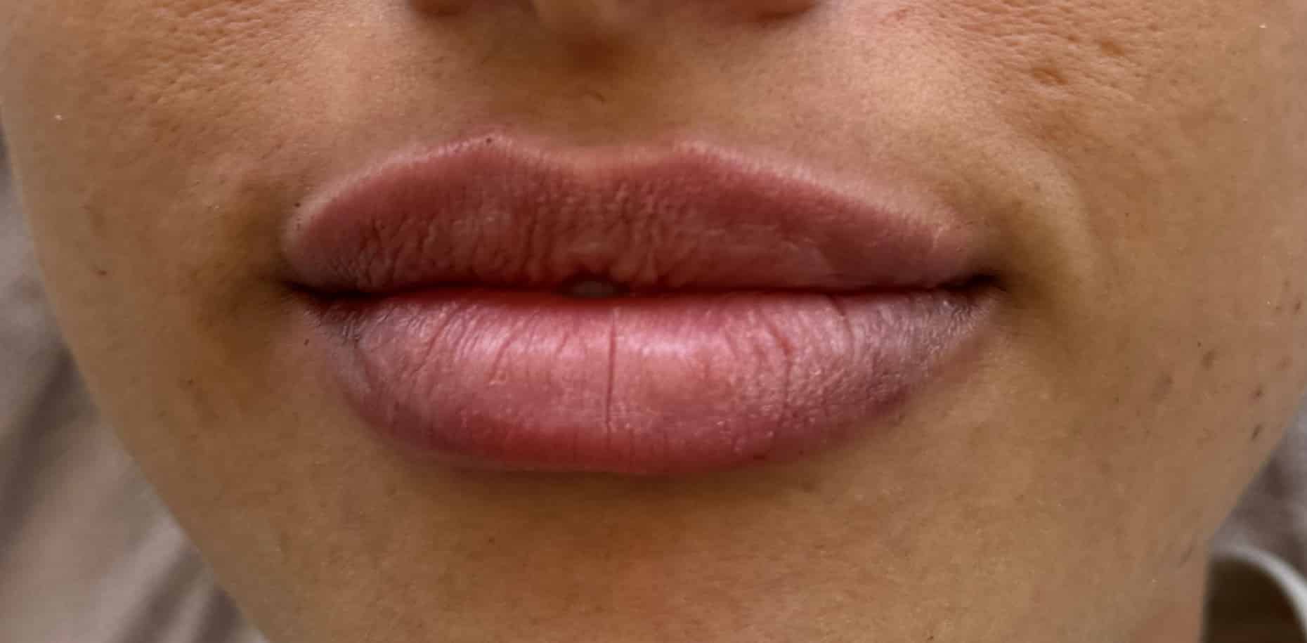 After Image: Lip Filler - front