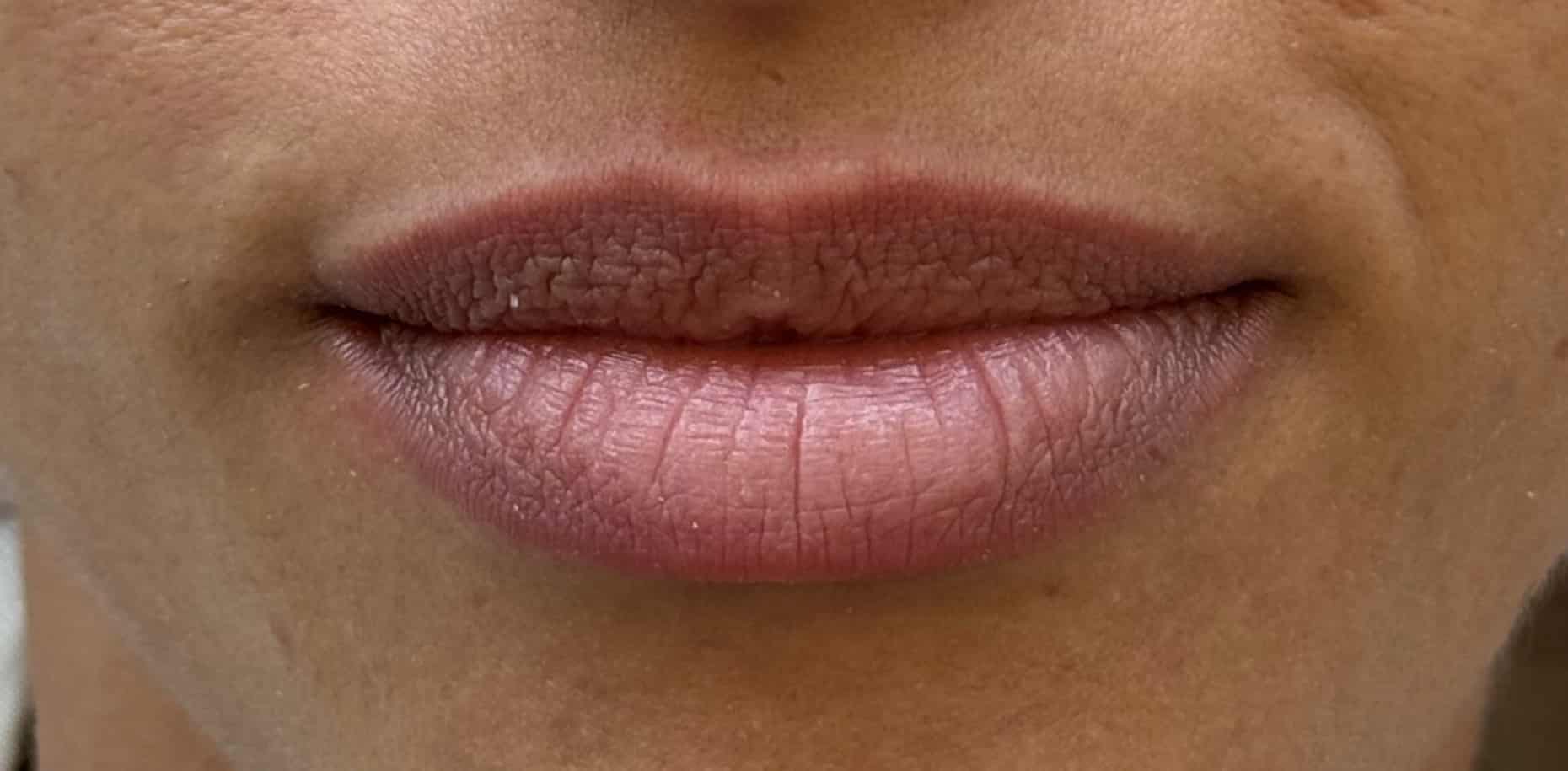 Before Image: Lip Filler - front