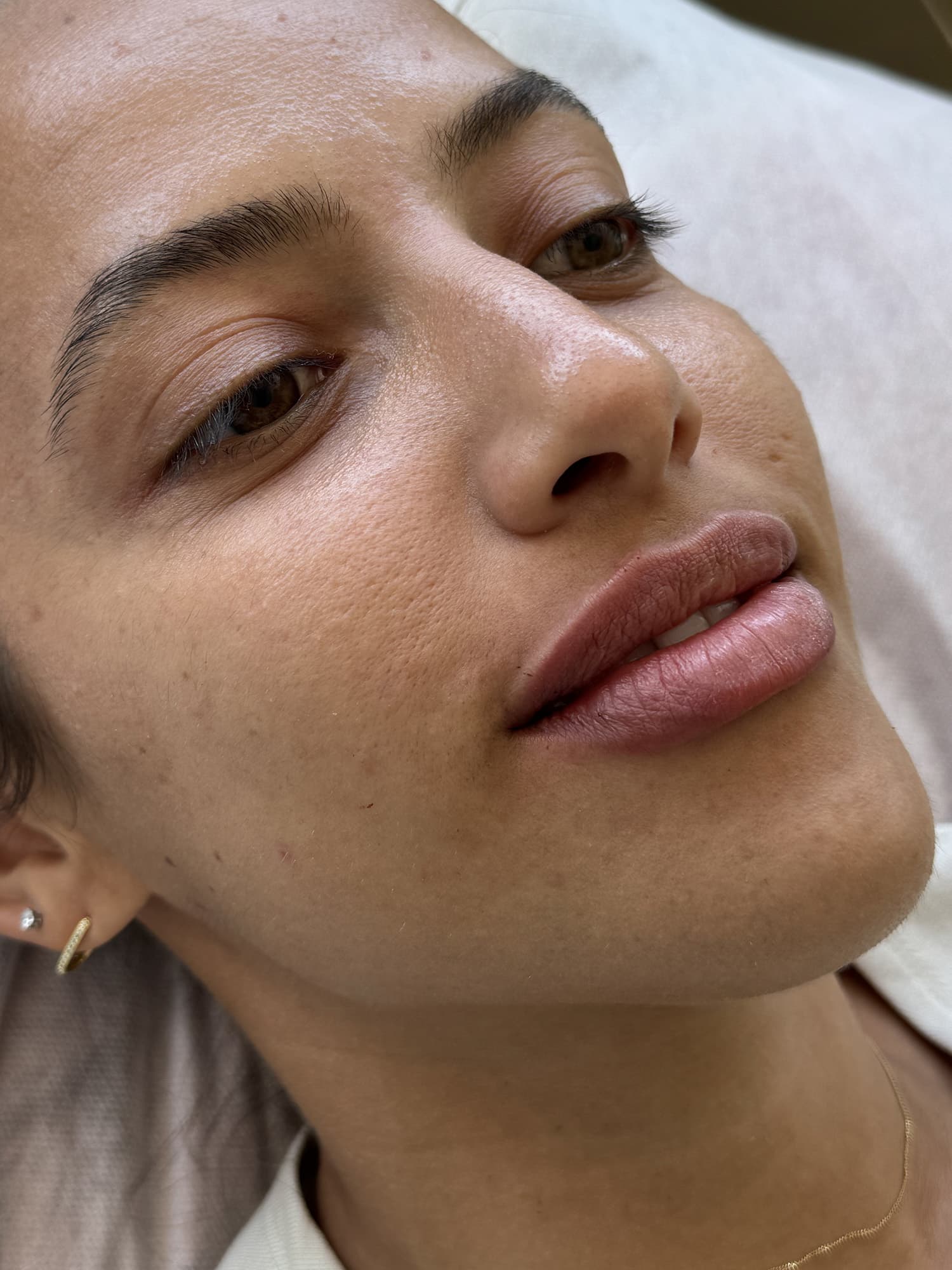 After Image: Lip Filler - right-front-oblique