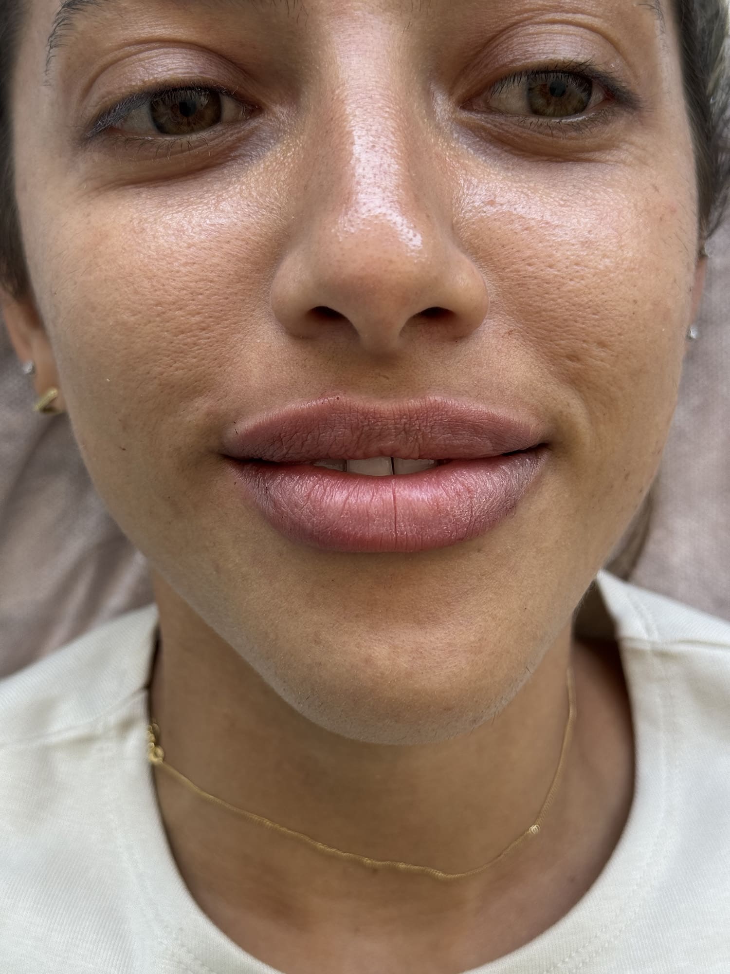 After Image: Lip Filler - front