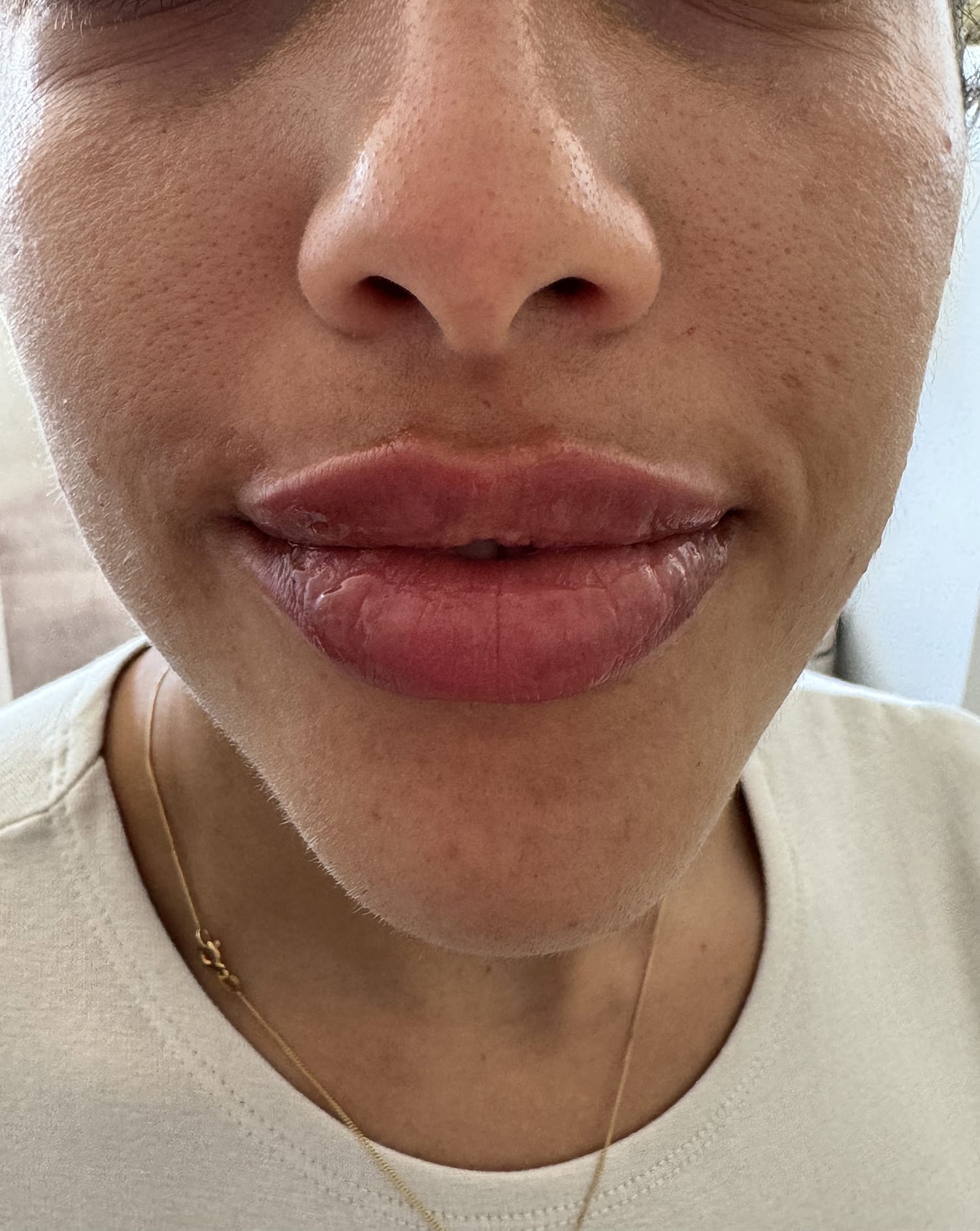 After Image: Lip Filler - front