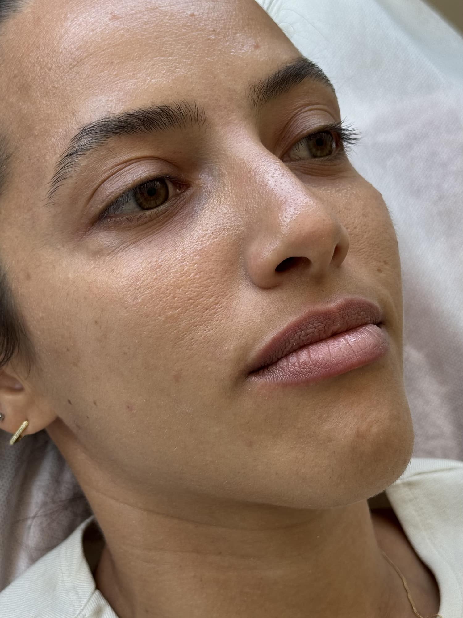 Before Image: Lip Filler - right-front-oblique