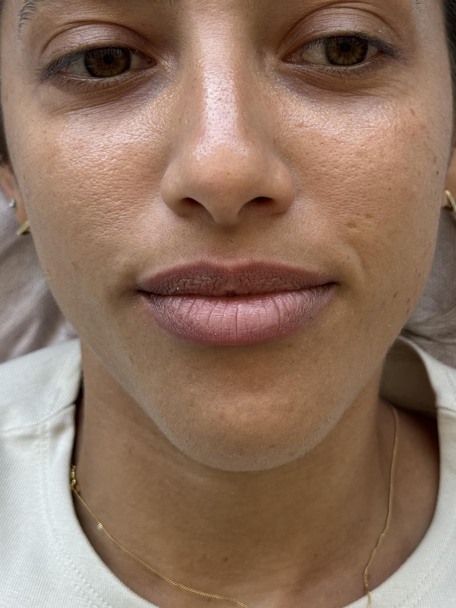 Before Image: Lip Filler - front