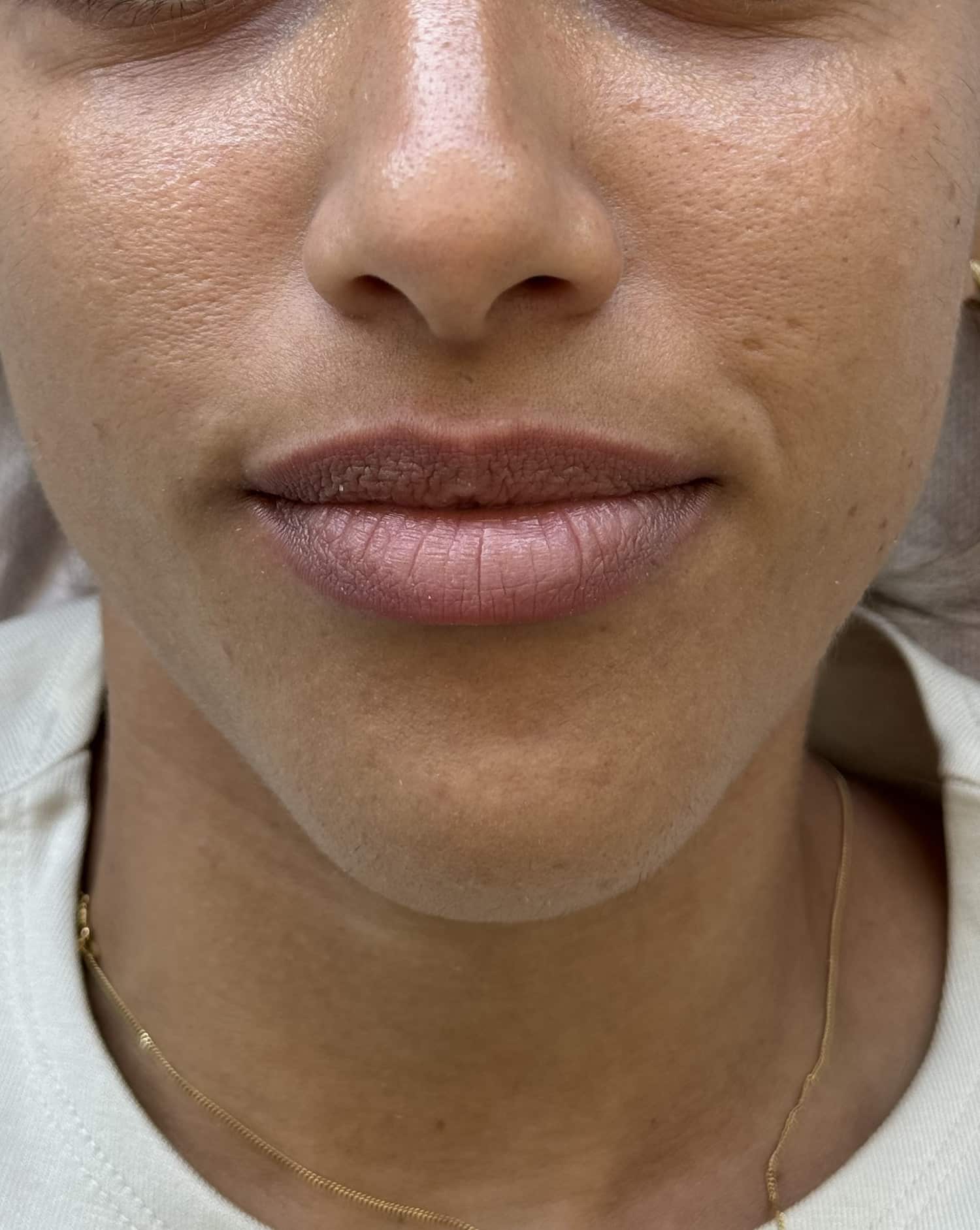 Before Image: Lip Filler - front