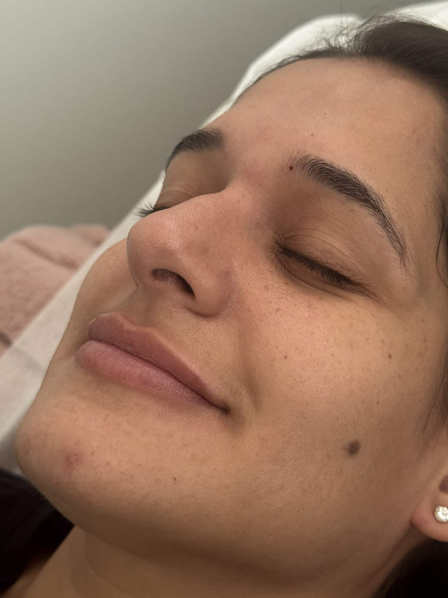 Before Image: Lip Filler - left-front-oblique