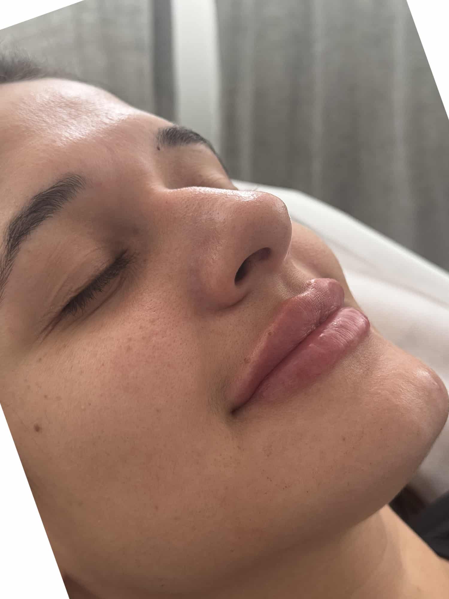 After Image: Lip Filler - right-front-oblique