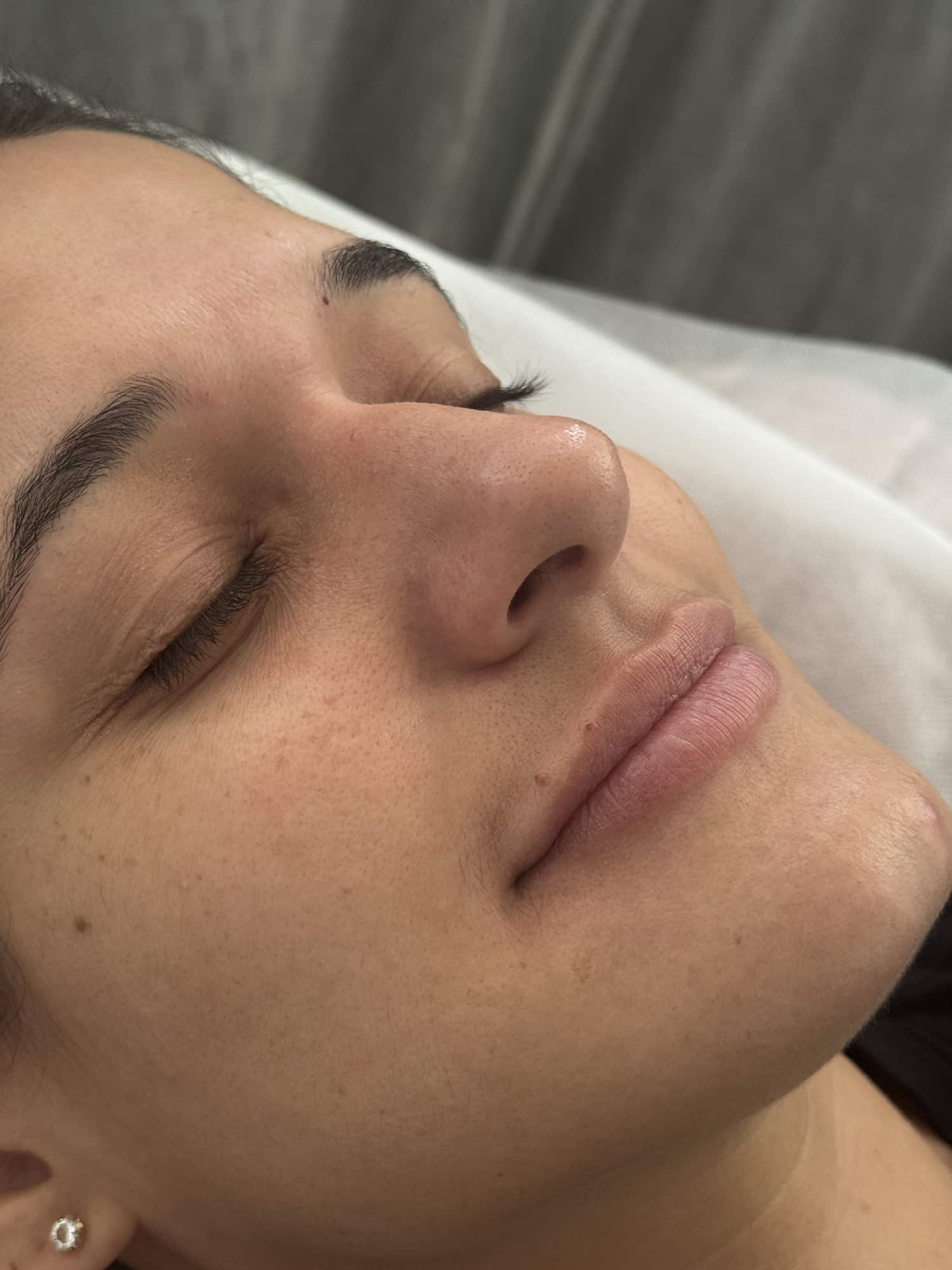 Before Image: Lip Filler - right-front-oblique