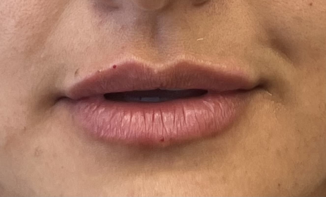 After Image: Lip Filler - front