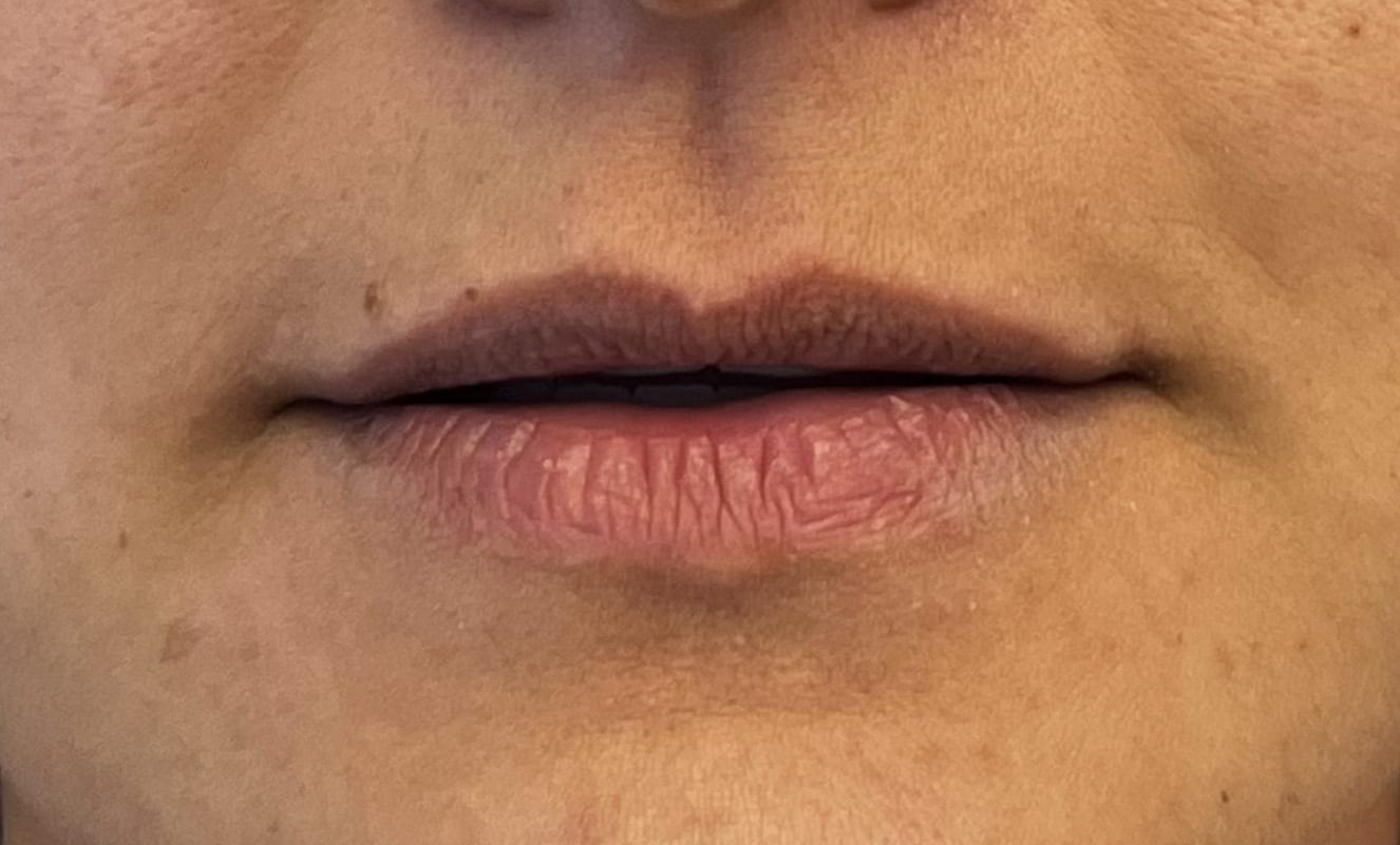 Before Image: Lip Filler - front