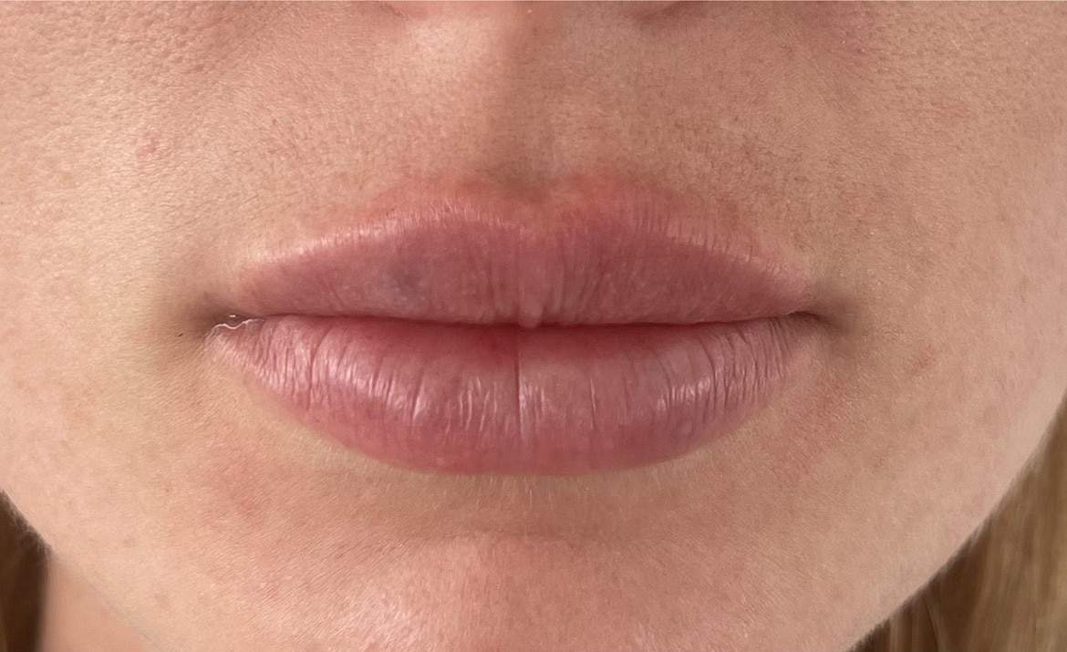 After Image: Lip Filler - front