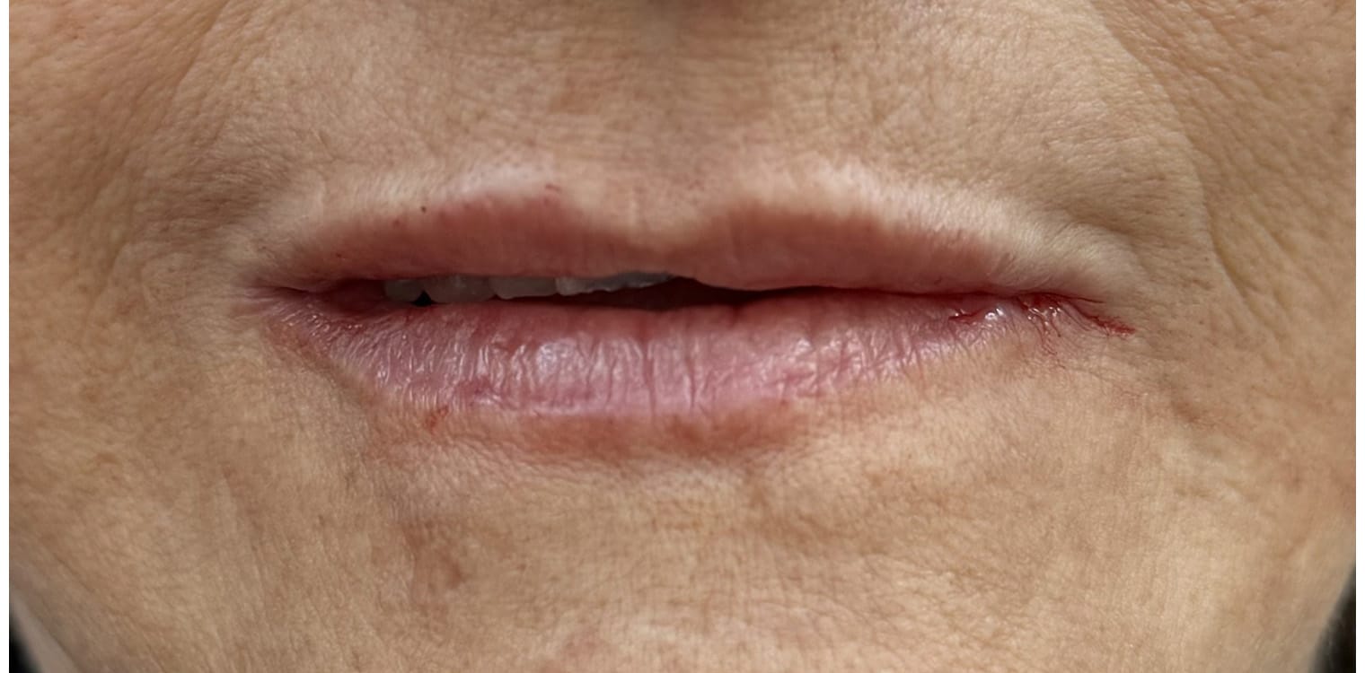 After Image: Lip Filler - front